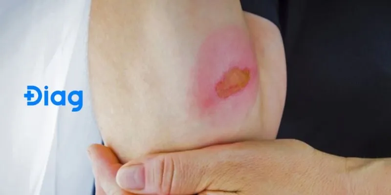 Các vết bỏng